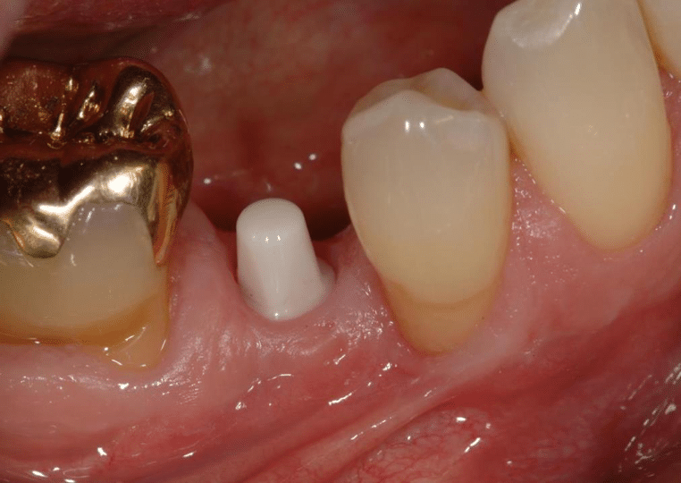 Einzelzahnversorgung mit Keramikimplantat: Keramikstumpf