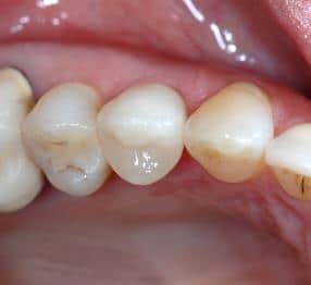 Seitenzähne