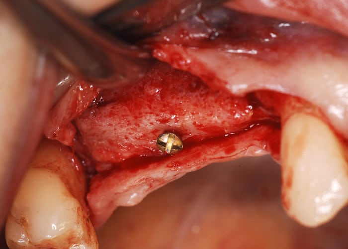 Klinische Situation nach eingeheiltem Beckenkamm vor Entfernung der Osteosyntheseschrauben