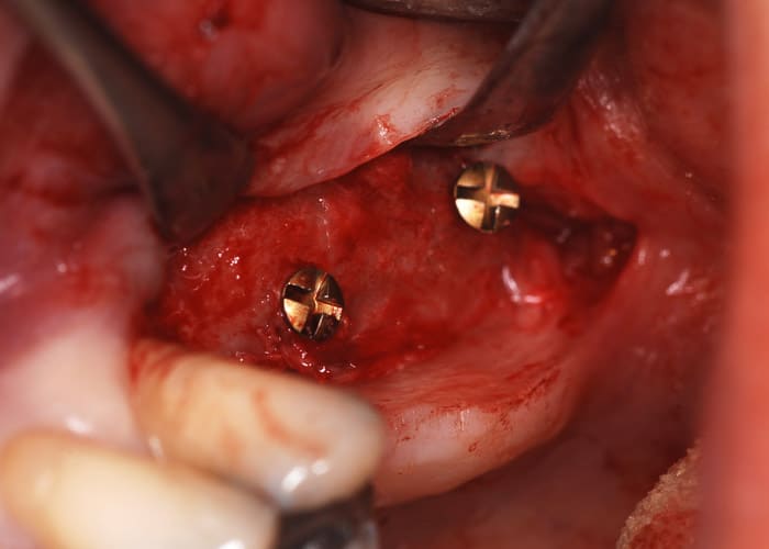 Klinische Situation nach eingeheiltem Beckenkamm vor Entfernung der Osteosyntheseschrauben