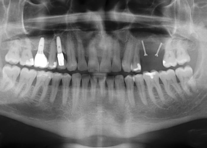 Röntgenkontrolle nach Vertikalaugmentation eines Beckenkammtransplantates mit Fixierung durch 2 Osteosyntheseschrauben