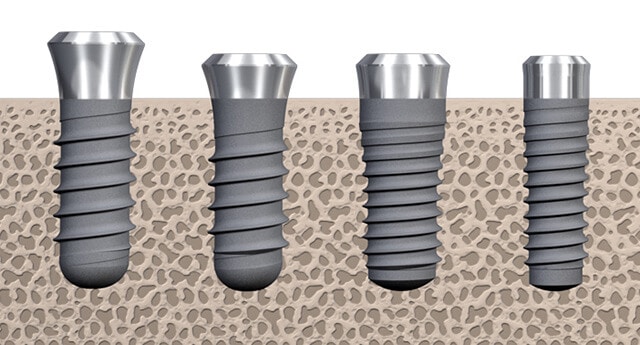 Titanium implants