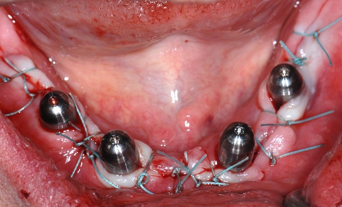 Klinische Situation nach Einsetzen der Implantate