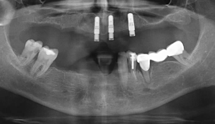 Röntgenkontrolle mit den eingeheilten Implantaten