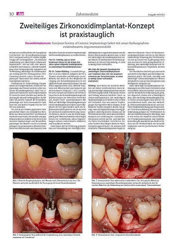 Artikelvorschau dzw: Zweiteiliges Zirkonoxidimplantat-Konzept ist praxistauglich